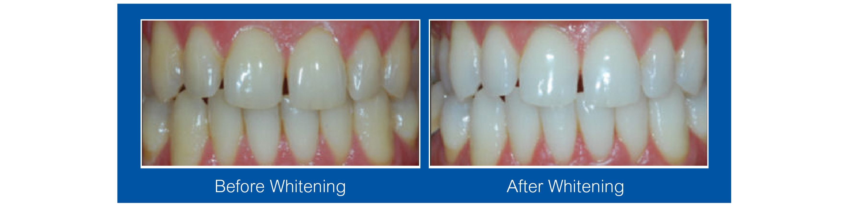Teeth Whitening Waterloo